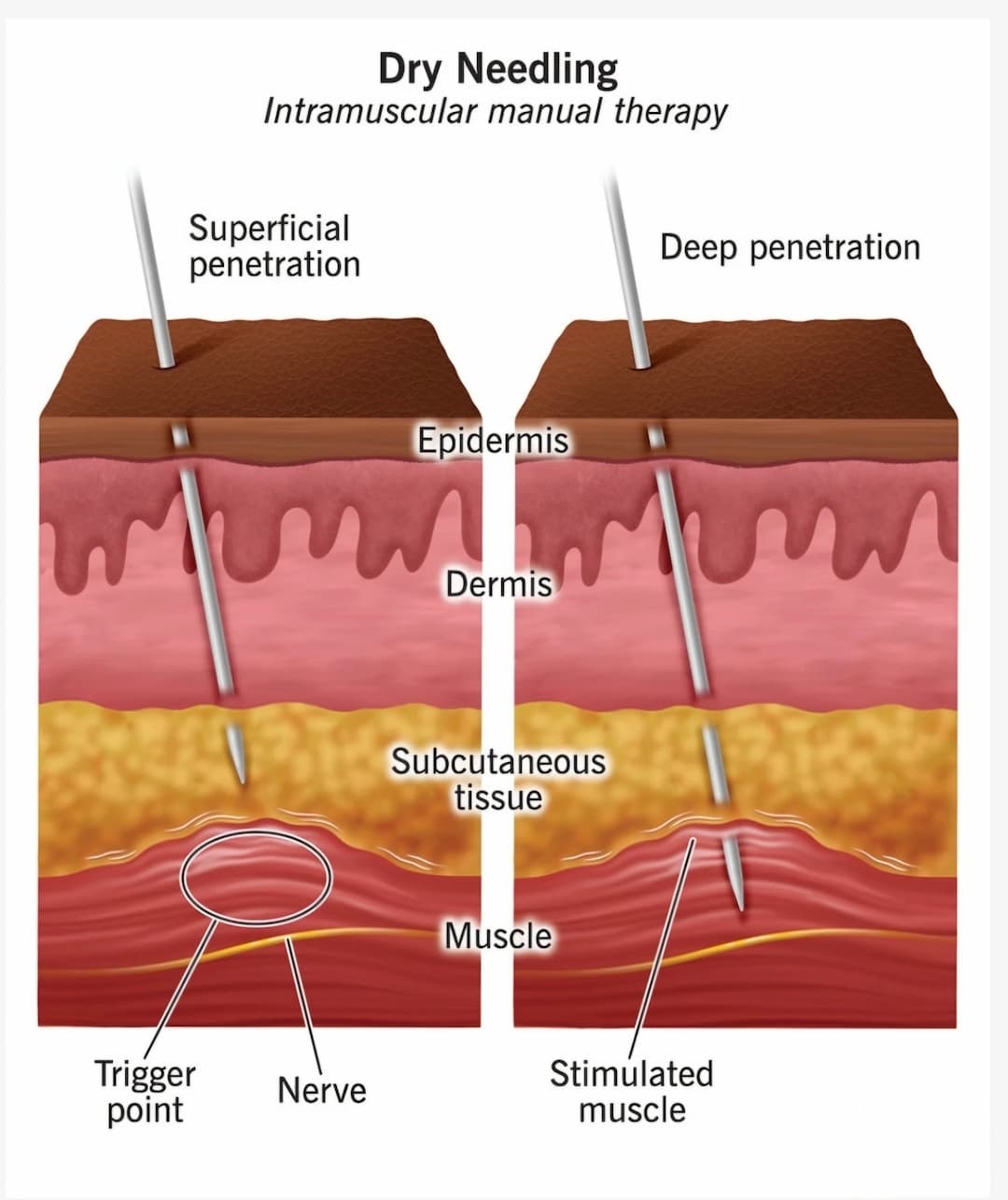 Dry Needling Therapy